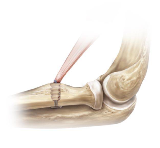 Fixação do biceps com auxílio de 01 parafuso