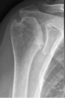 Osteonecrose após fratura do ombro