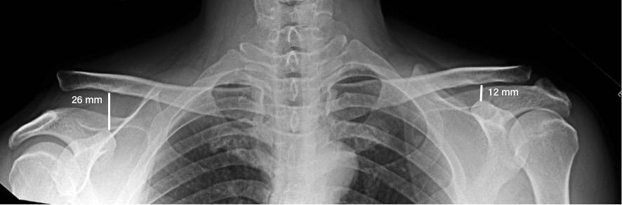 Radiografia demonstrando luxação acromioclavicular tipo 5 com desvio superior a 100%