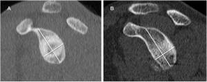 A: ombro normal B: ombro com desgaste da região anterior da glenoide