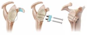 Cirurgia de Latarjet