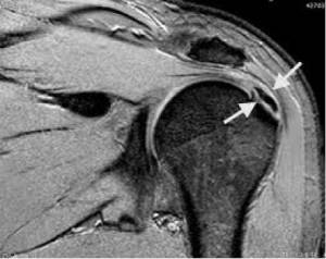 Ressonância magnética demonstrando calcificação no tendão supraespinal