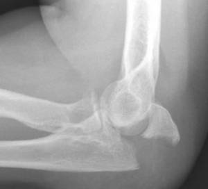 Fratura da ulna proximal (olécrano)