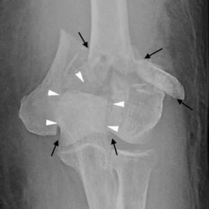 Fratura do úmero distal (cotovelo)