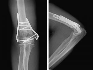 Fratura do úmero distal tratada com placa e parafusos