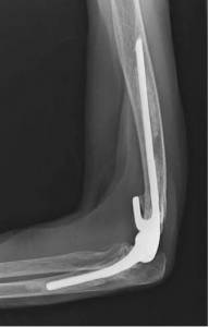 Fratura do úmero distal tratada com prótese