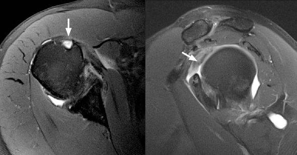 Ressonância magnética demonstrando ausência do biceps no ombro pela ruptura