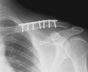 fratura_clavicula