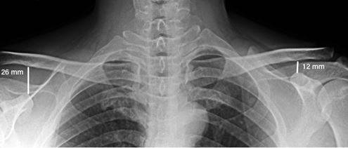Luxação acromioclavicular do tipo V