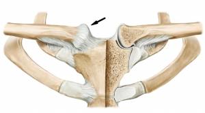 Articulação esternoclavicular (seta)