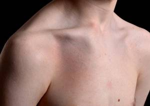 Luxação esternoclavicular com deformidade aparente