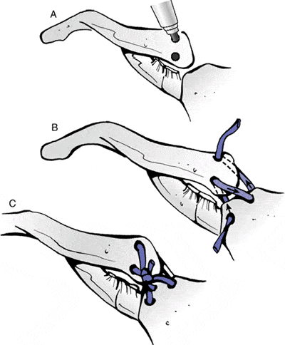 Legenda: Reconstrução da articulação esternoclavicular