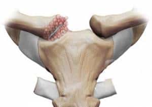 Legenda: Artrose esternoclavicular