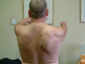 Discinesia da escápula ou escápula alada por desequilíbrio muscular