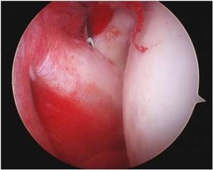 diabetes_ombro_3