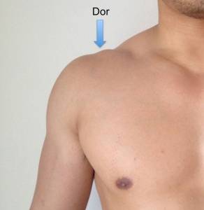Localização da dor na artropatia degenerativa (artrose) acromioclavicular