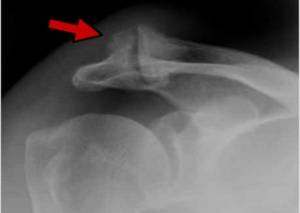Radiografia do ombro com sinais de artropatia degenerativa (artrose) acromioclavicular