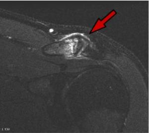 Ressonância magnética demonstrando artrose acromioclavicular