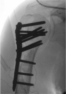 Fratura do úmero proximal fixada com placa e parafusos
