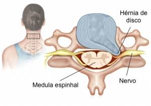 Hérnia de disco comprimindo uma raiz nervosa da coluna cervical