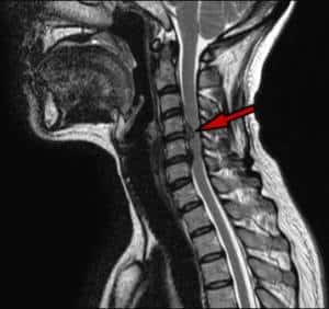 Ressonância magnética demonstrando uma hérnia de disco cervical
