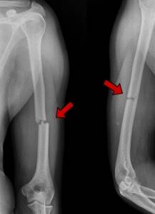 Radiografia de uma fratura da diáfise do úmero (fratura do braço)