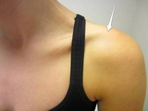 Localização da dor na osteólise da articulação acromioclavicular